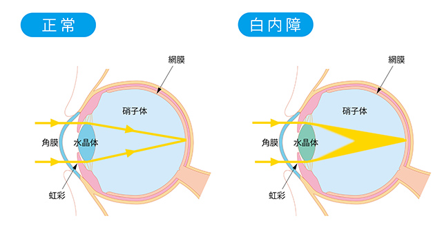 白内障のイラスト